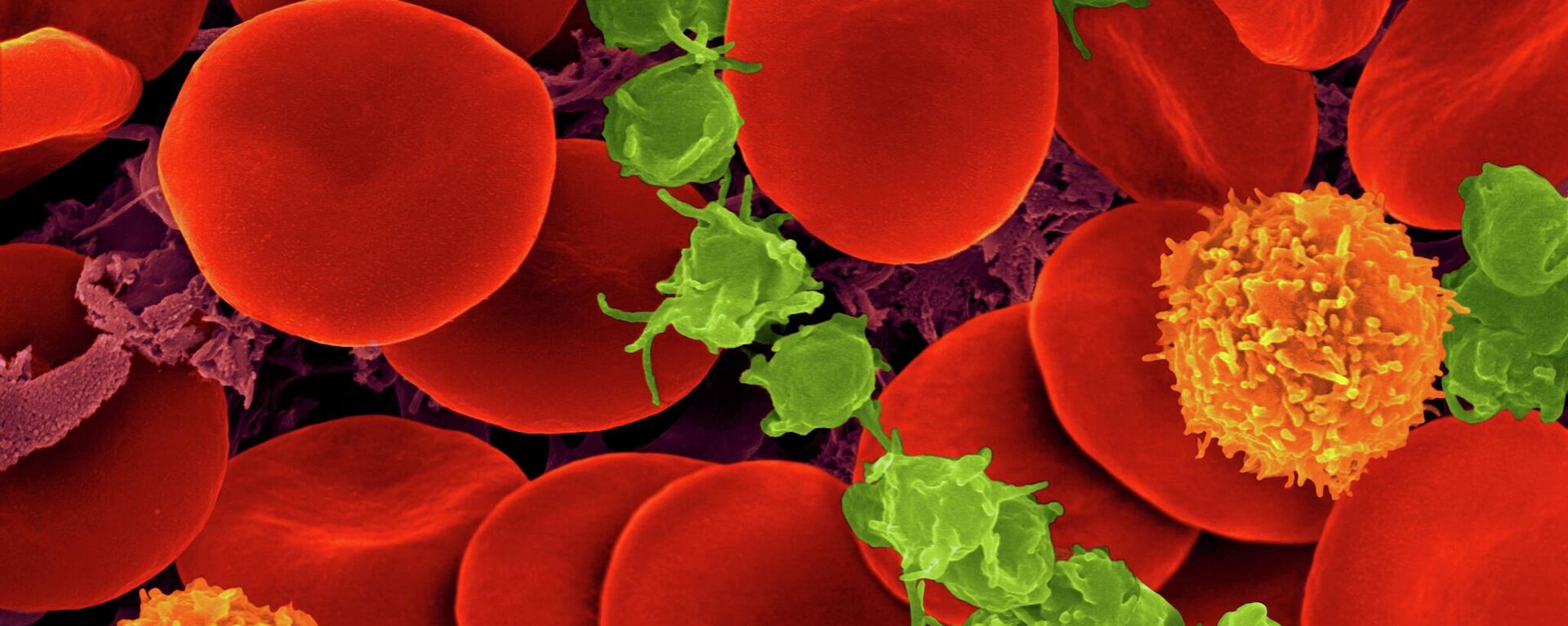 Људска крв са црвеним крвним зрнцима, Т ћелијама (наранџаста) и тромбоцитима (зелена) - Sputnik Србија, 1920, 07.08.2022
