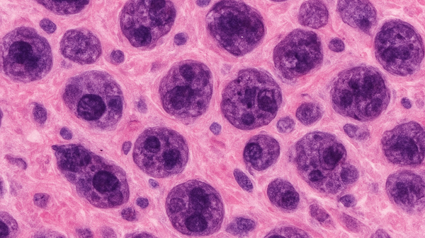 Ćelije melanoma pod mikroskopom - Sputnik Srbija